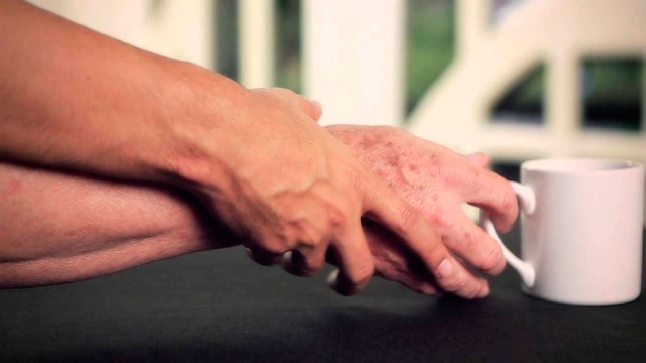 Pacientes con Parkinson pueden logra calidad de vida con tratamiento