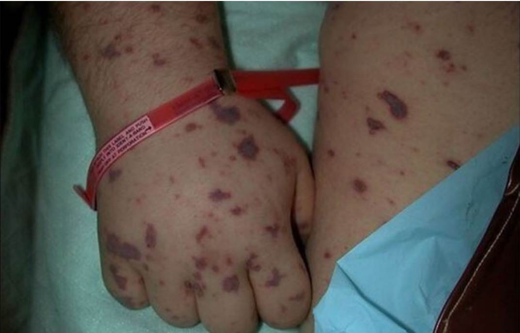 Con estornudos se transmite bacteria que mató a niño