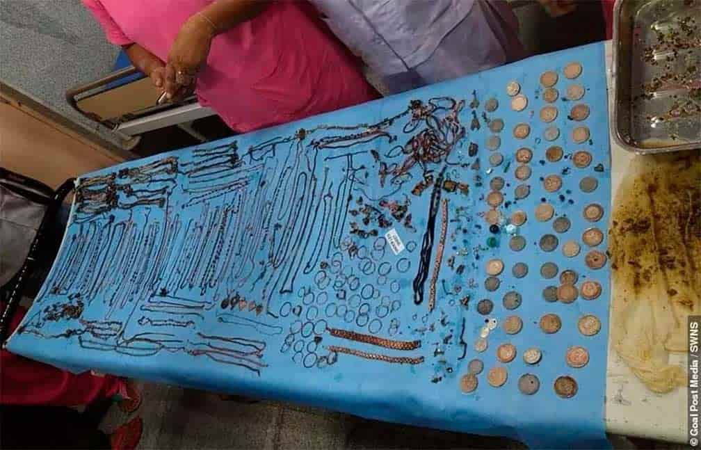 ¡Increíble! Extraen más de un kilo de joyas del estómago de una joven en la India
