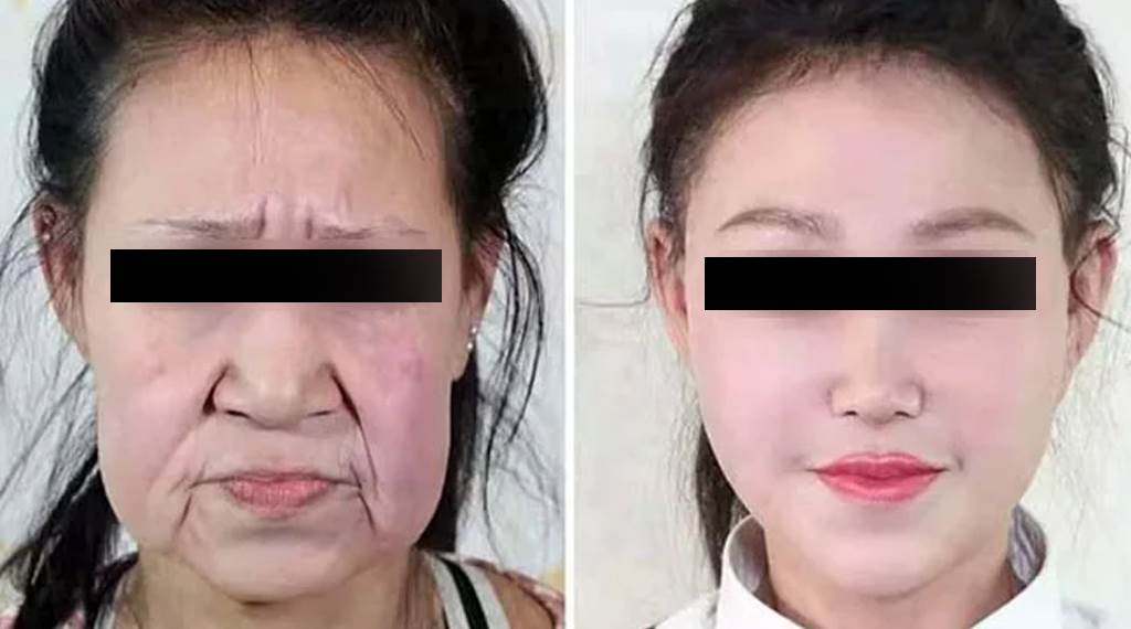 Cirujanos plásticos devuelven la juventud a quinceañera con rostro de anciana