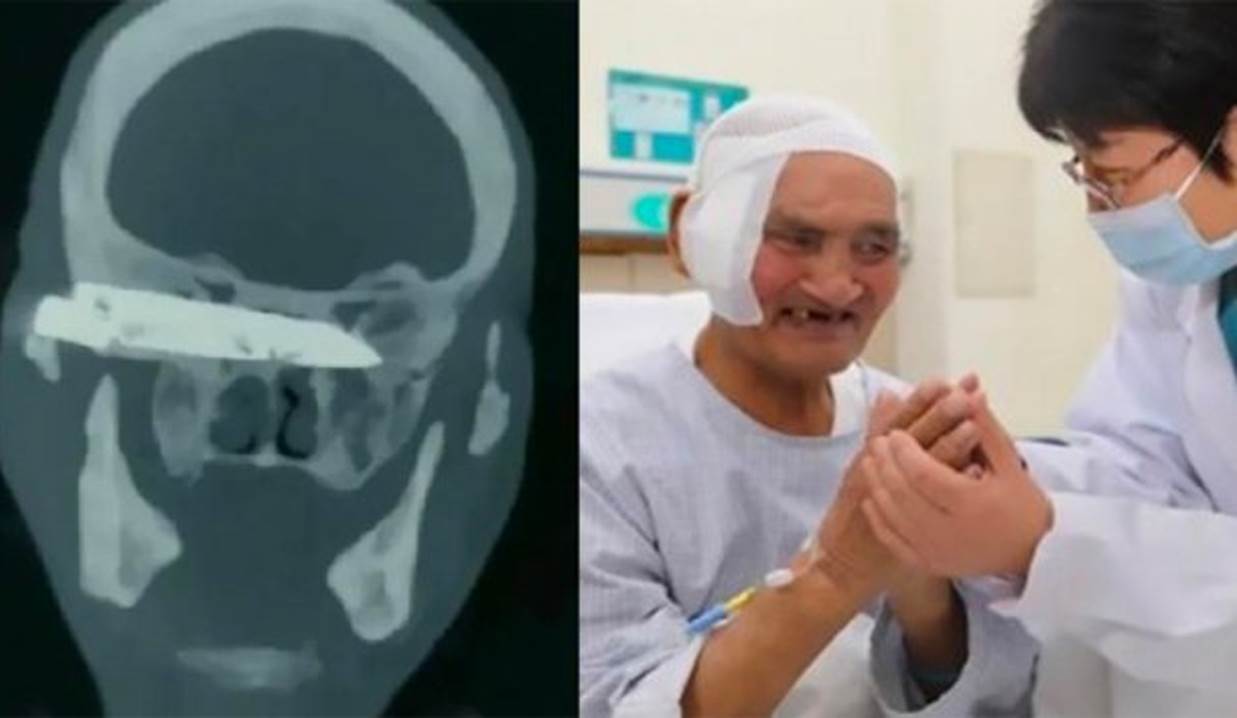 Extraen exitosamente un chuchillo oxidado de cabeza de anciano