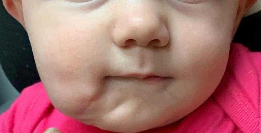 ¡Insólito! Bebé nace con dos bocas y dos lenguas