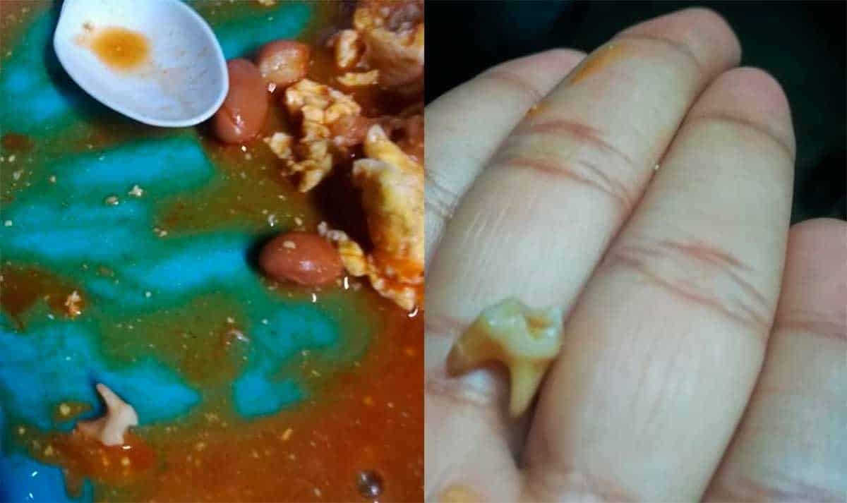 ¡Asqueroso! Joven muerde algo duro mientras comía frijoles y descubre que era una muela