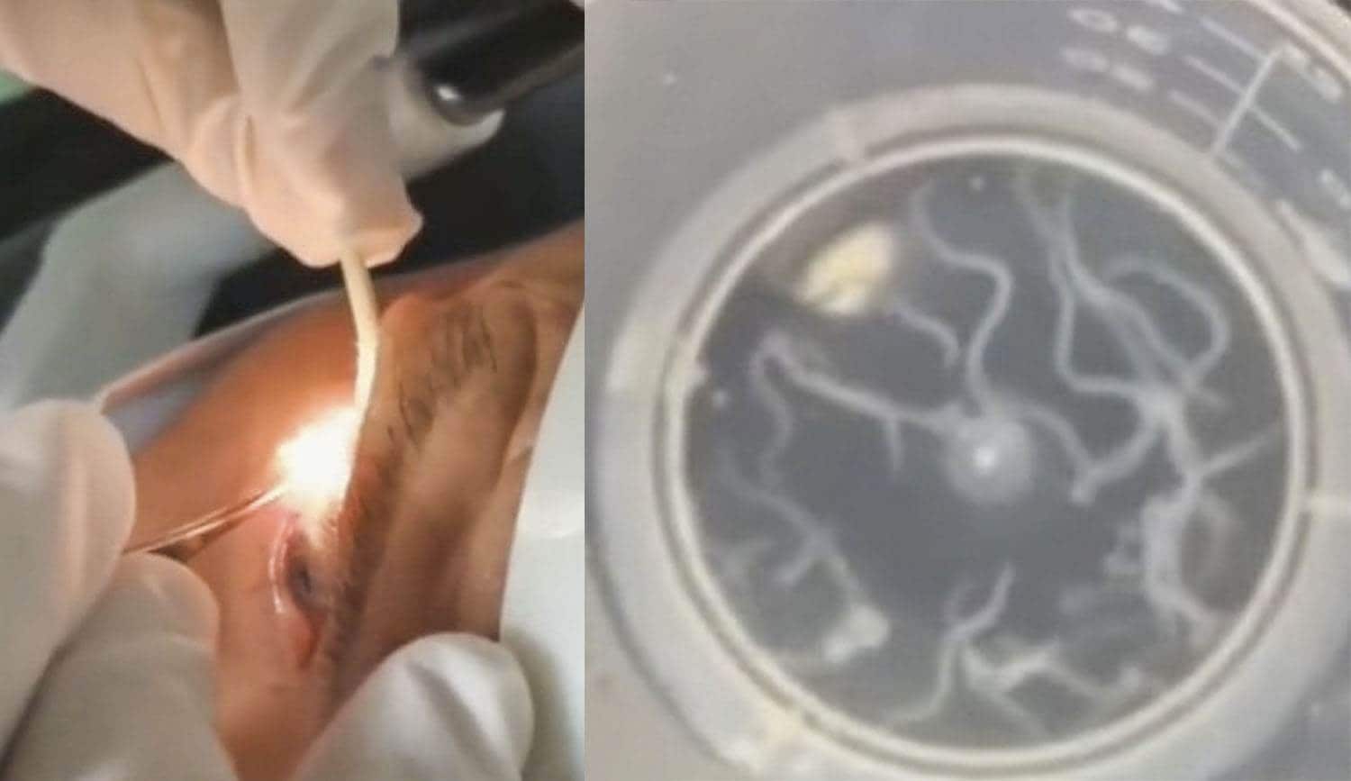 Le sacan del ojo 20 gusanos que vivieron allí durante un año