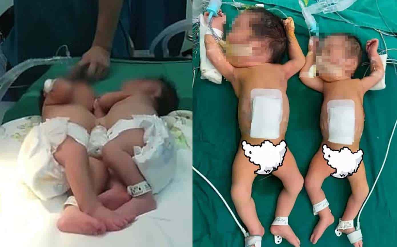 Médicos chinos logran separar exitosamente a gemelas que nacieron unidos del estómago