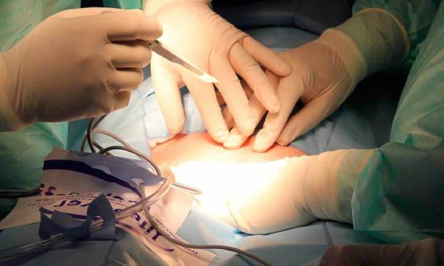 Le extraen una tijera del cuerpo.... ¡después de 20 años!